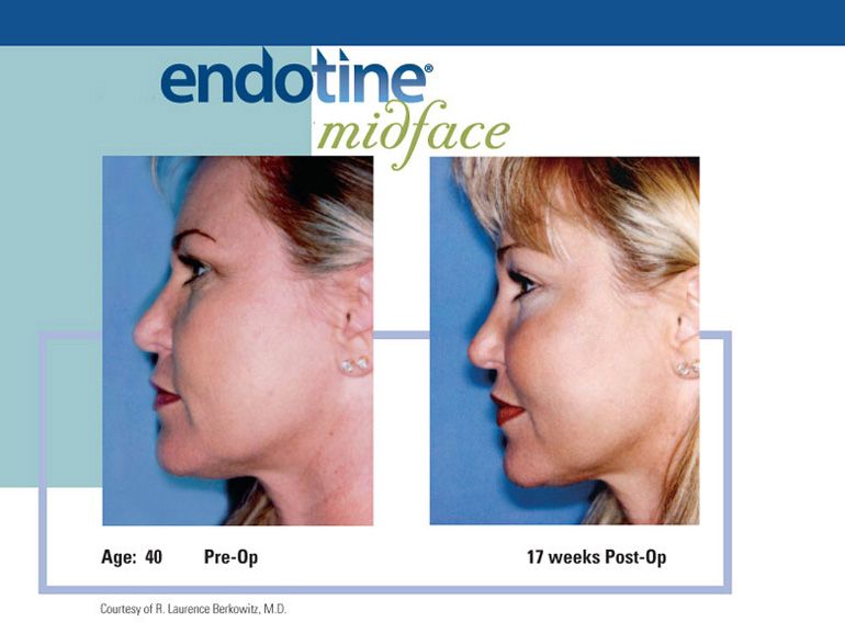 ENDOTINE Midface Before & After 1