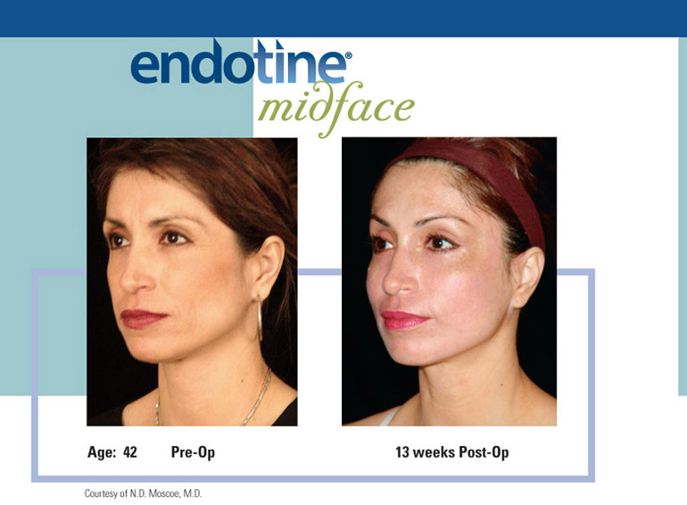 ENDOTINE Midface Before & After 2
