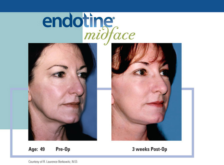ENDOTINE Midface Before & After 3