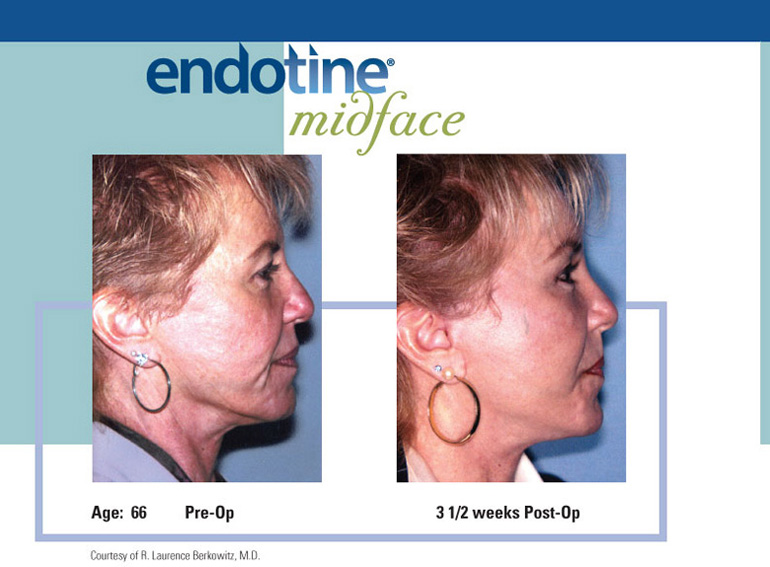 ENDOTINE Midface Before & After 4