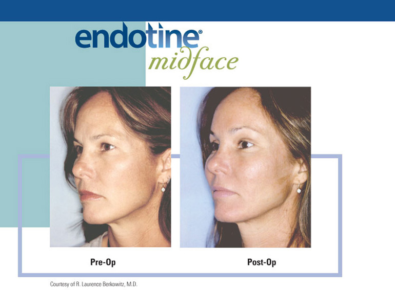 ENDOTINE Midface Before & After 7