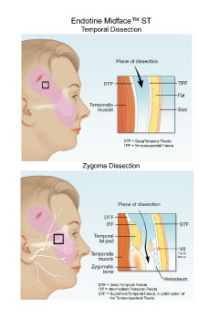 ENDOTINE Midface Dissection planes